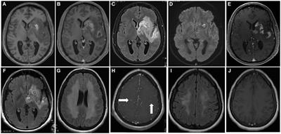 Primary CNS vasculitis: insights into clinical, neuropathological, and neuroradiological characteristics